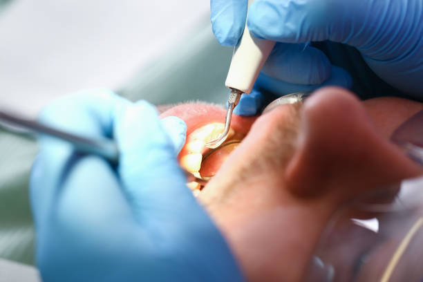 Best Emergency Dental Care for Sports Injuries in Pismo Beach, CA